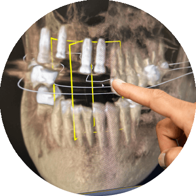 dr palayam pointing at implant 3d model