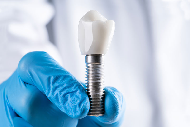 a close-up picture of a doctors gloved hand holding a single dental implant that will be accurately placed in the patients mouth with the Yomi robot.