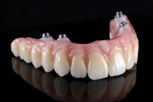 zirconia full arch