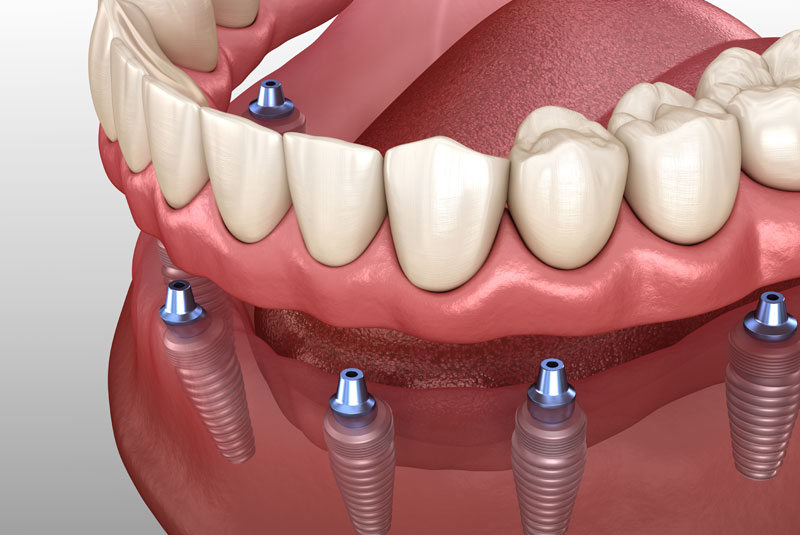 Image of an implant supported dental model.