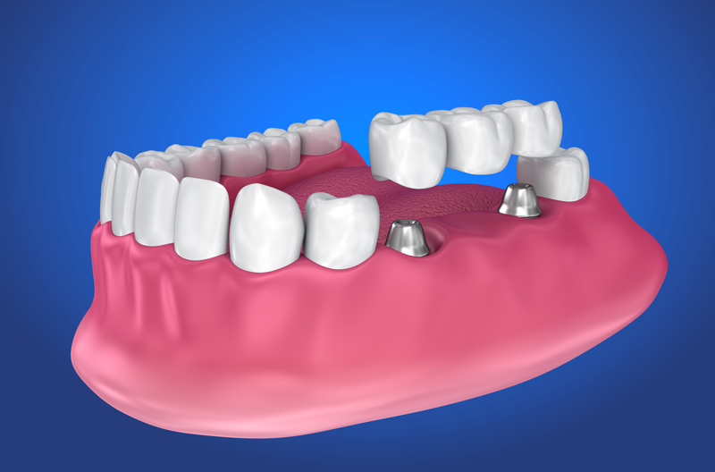 3d image of a dental implant bridge and a prosthesis jaw with a blue backdrop.