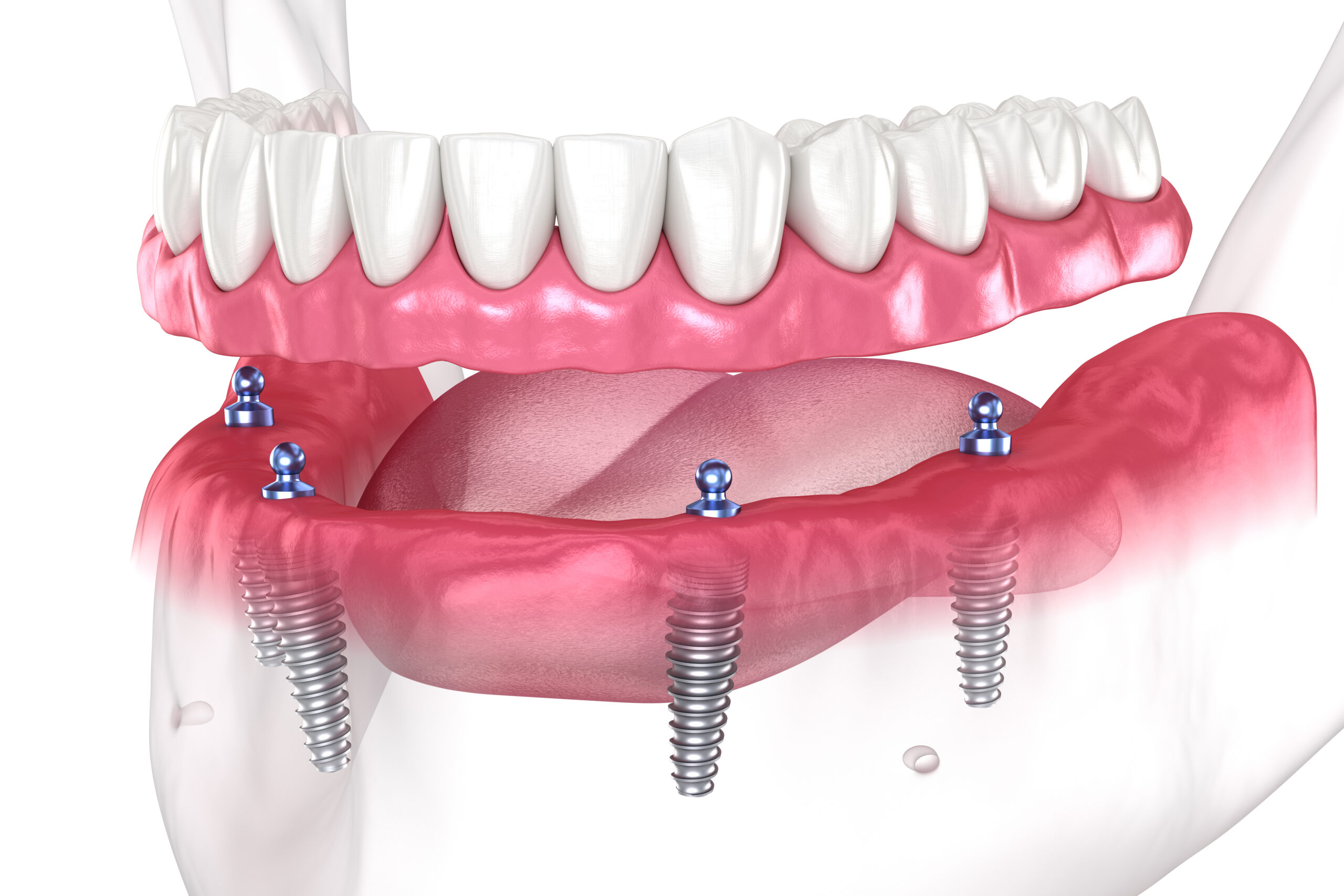 Dental prosthesis based on 4 implants. Dental 3D illustration.
