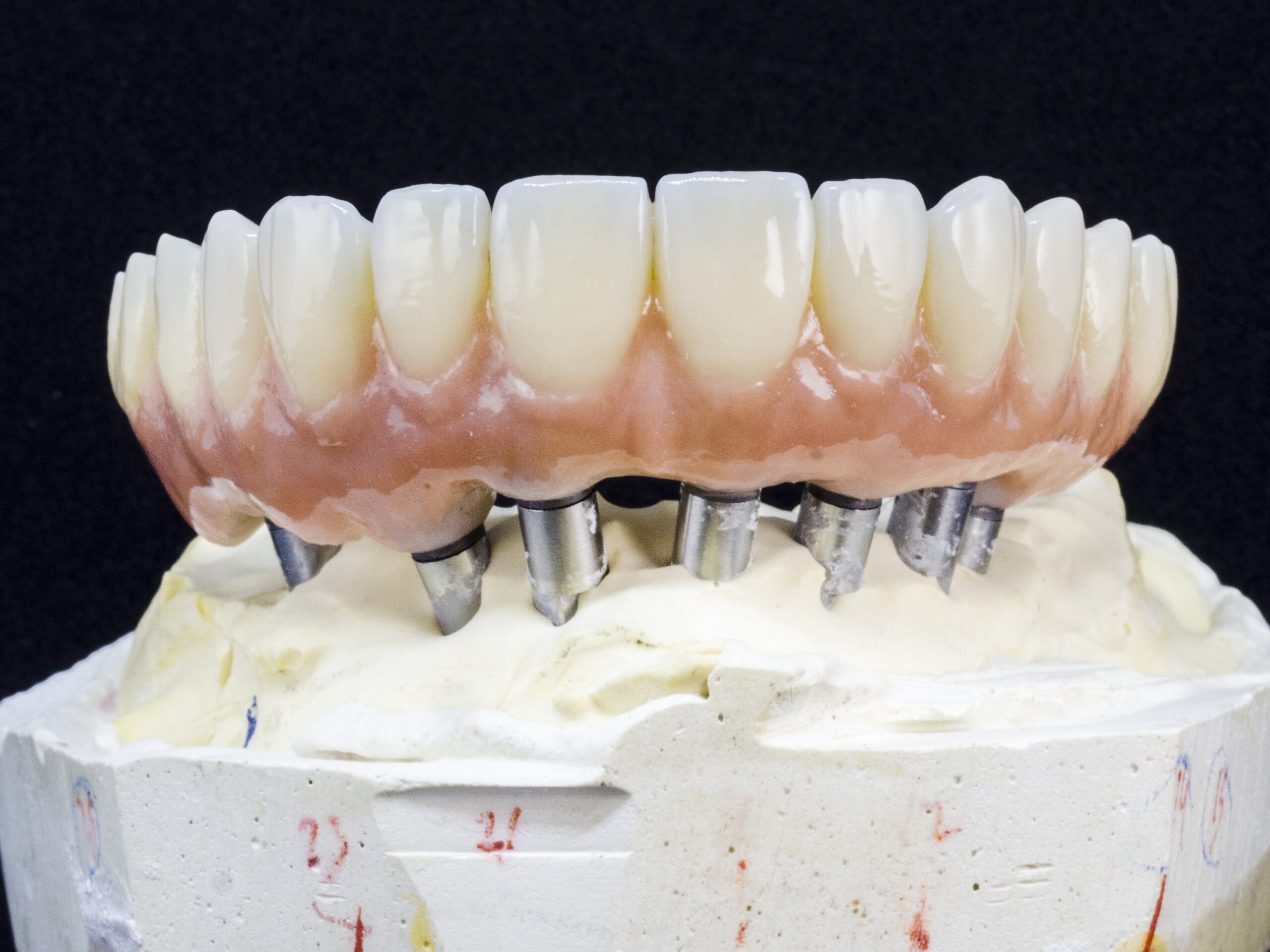 an image of implant supported dentures.