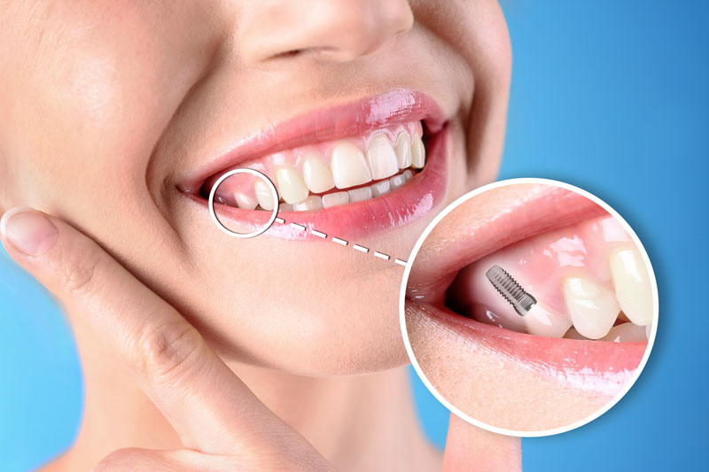 Female smiling with a diagram showing where her dental implant is at; blue background
