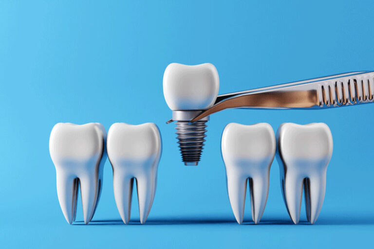 Your Comprehensive Guide on Dental Implants The Best Replacement of